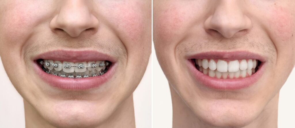Teen smile before and after braces treatment – deep overbite correction